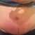 Scar at 3 wks 3 days , scab in the middle.