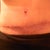 20 day PO... Tummy scar and bb. Healing very well. :)