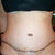 Front: 10 days post-op