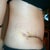 Side: 10 days post-op