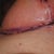 Much of the redness is from a rash - allergic reaction