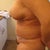 4 days post op