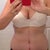 4.5 months post op.