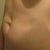 showing the canyon from muscle separation, and the bulgy hernia bellybutton.