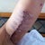 This is about 2 weeks post op.  Notice how the stitches seem squeezed and the skin pops out.  It flattens out completely later.