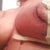 Fine detail stitching. Day 3 again... Dr gumucio did a wonderful job... Very detailed
