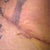 8 days after surgery... It was necessary for my incision to be extended.... But with beautiful incision, I know it wont be noticeable in a couple of months.