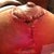 two weeks post op. after steri strip was taken off :( the beginning stages of wound separation