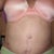 8 months post op