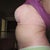 8 months post op left side