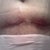 Week 3 - up close of scar. Looks a little infected