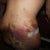 bad bruising and some swelling