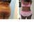 Before and 1 week After PO back.