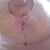 Right breast incision...this what happens when one over does it!