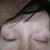 eyes not cut even, right eye cant shut and lower lid being dragged down 5 weeks post op