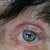 Lower right lid being dragged down causing much pain, both eyes swollen every day pulling on scar...5 weeks post op
