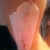 Right arm 1 week post op
