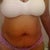 Pre- surgery A front view of "Da Flab"
