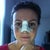 Post Op - Day 7 (day of cast removal)