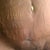 closer look of whats left of the seroma