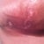 The right breast started healing also!!!