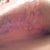 Scar under my Right breast as of 1/13/2013 (I can live with it) could be worse...