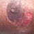Right side. My problem area. It continues to open from time to time after it heals.