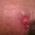 Left side. My problem area. It continues to open from time to time after it heals.