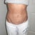 William Bruno, MD answers: Deflated look after Mini Tummy Tuck and Liposuction?
