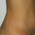 The day of surgery (pre-op)