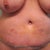 6 days post-op; bruised and swollen