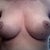 3 weeks post op