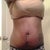 Pre op. A little worried about skin tightening but dont want a tummy tuck