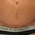 close-up of scar, 5 weeks out