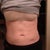 1.5 weeks after sides.  5 weeks after upper stomach. Line is pretty much gone, and now my lower stomach looks huge in comparison!