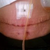 Two weeks post TT