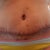 13 days post-op. Scabs are starting to fall off!