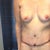 10 days post op