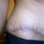 you can see the stretch marks coming up from my scar and still around to my sides. :( depressing.