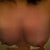 4 days post op- Leaning forward