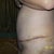 post op 9 days I know I am still very swollen!