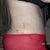 post op 9 days so happy the flap is gone though!  lol