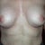 One month post op