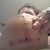 incision sites