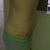 A little over two weeks post op. 

AM photo
