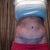 3 months post op