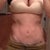 post op 18