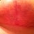 Week 8 Left Tzone.   Boy that Palmers is great.  Scars are already starting to look even better.