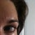 DURING hyaluronidase treatment. Still a small bulge under left eye after 5 rounds of injections to dissolve the filler. It dissolved unevenly.