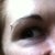 DURING. After several months of Hyaluronidase. Still overly full lower lid with Tyndall effect (blue/purple color through skin). No wrinkles or folds when smiling yet because the skin is still heavily inflated with filler.